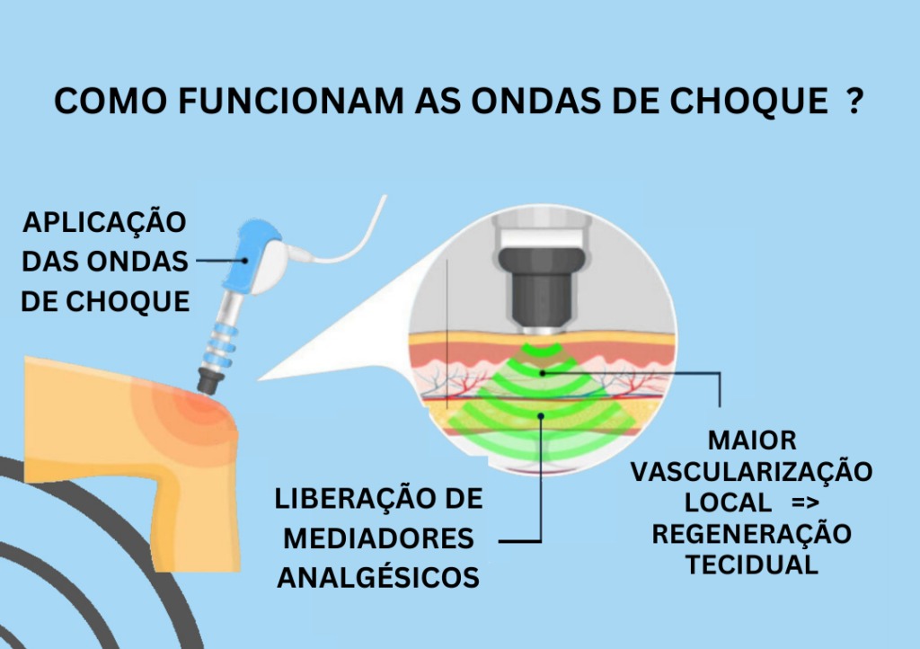 terapia por ondas de choque - Eduardo Neri - Ortopedista - tratamento ondas de choque - fisioterapia